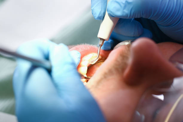 Best Emergency Tooth Extraction in Argentine, MI
