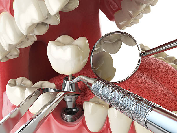 Best Emergency Tooth Extraction in Argentine, MI